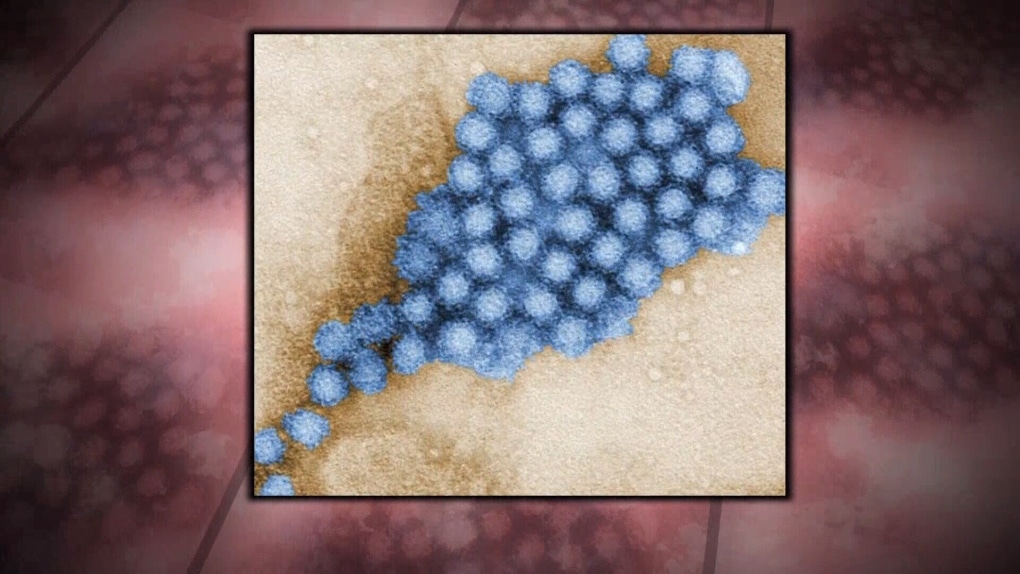 انتشار فيروس نوروفيروس يتسبب بغلق منتجع فى أوتاوا